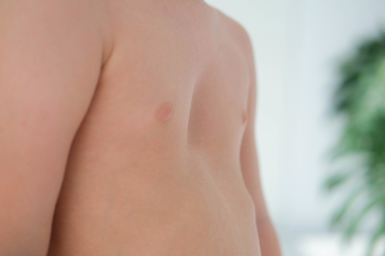 Junge mit Trichterbrust